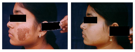 Chemical Peels Treatment in Salt Lake