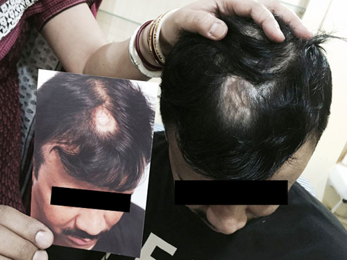 Prof. Dr. Rathindra Nath Dutta - General Dermatology :: Hair & Nails :: |  India, Kolkata, Male-pattern baldness, Female-pattern baldness,  Androgenetic alopecia, for, in, Treatment, Best, Top, Surgeon, Surgery,  Specialist, Bangladesh, Dhaka,