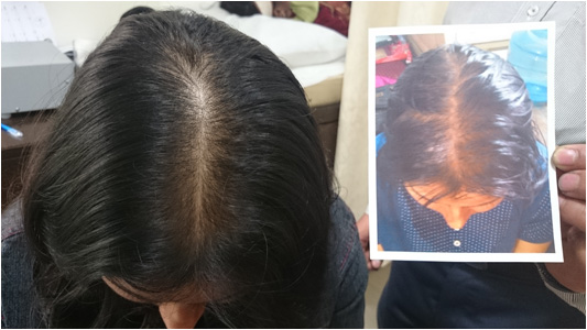 Prof. Dr. Rathindra Nath Dutta - General Dermatology :: Hair & Nails :: |  India, Kolkata, Male-pattern baldness, Female-pattern baldness,  Androgenetic alopecia, for, in, Treatment, Best, Top, Surgeon, Surgery,  Specialist, Bangladesh, Dhaka,